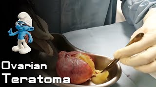 Hair in the Ovarian teratoma