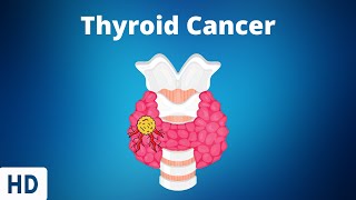 Thyroid Cancer: Everything You Need to Know