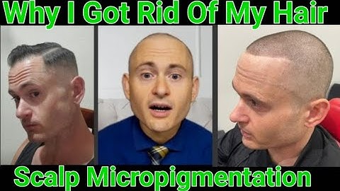Scalp Micropigmentation | SMP | Going Bald On Purpose! |