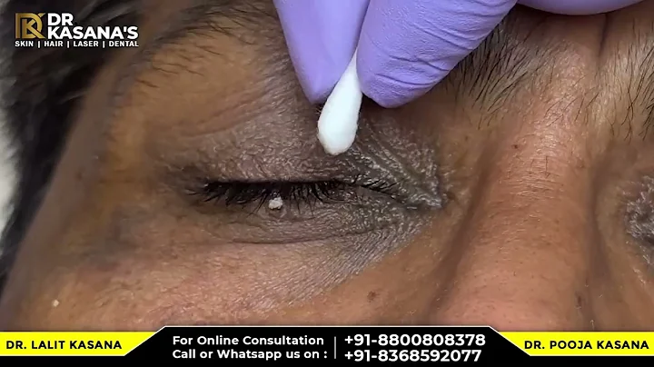 Milia Removal Treatment with RF technology By Dr Lalit Kasana #blackheads