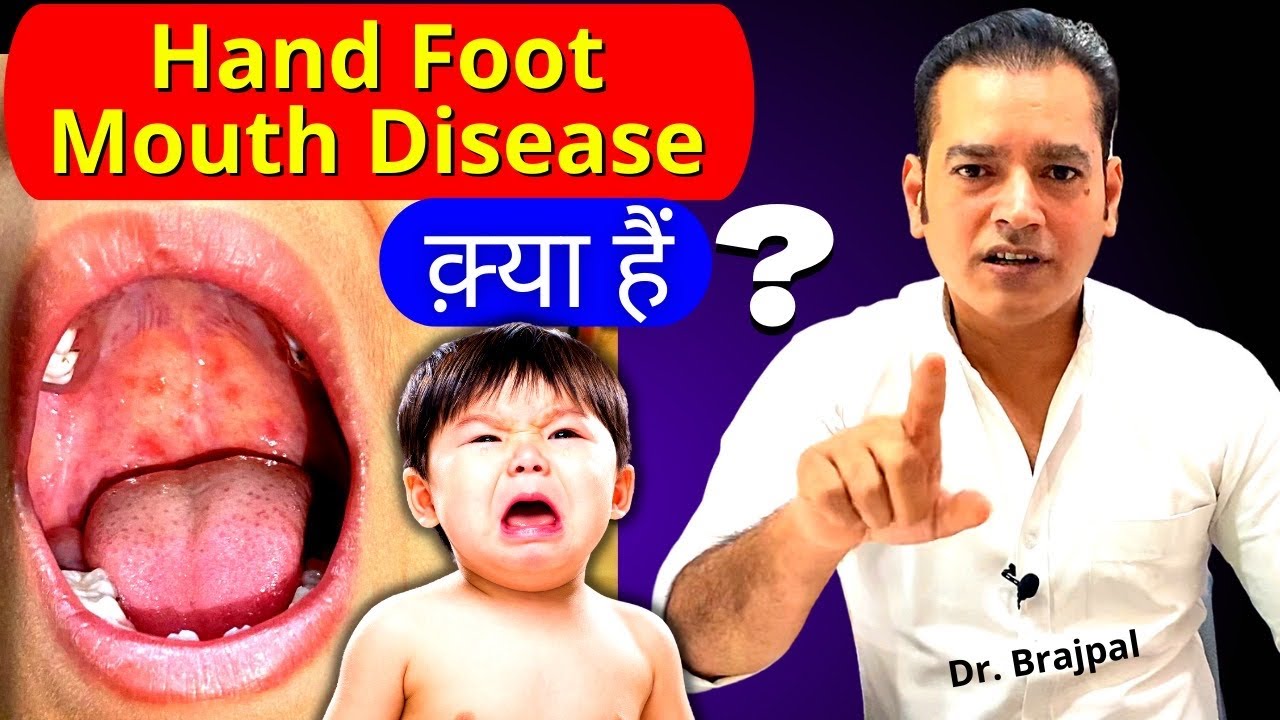 बच्चे के मुँह और शरीर पर छालें; कारण, ऊपाय ? By Dr Brajpal Hand Foot