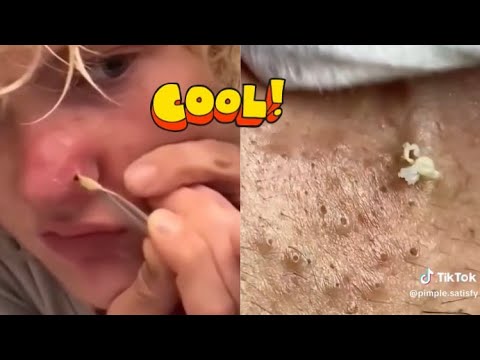 Ultimate Compilation of Satisfying Pimple Popping and Blackhead Extractions