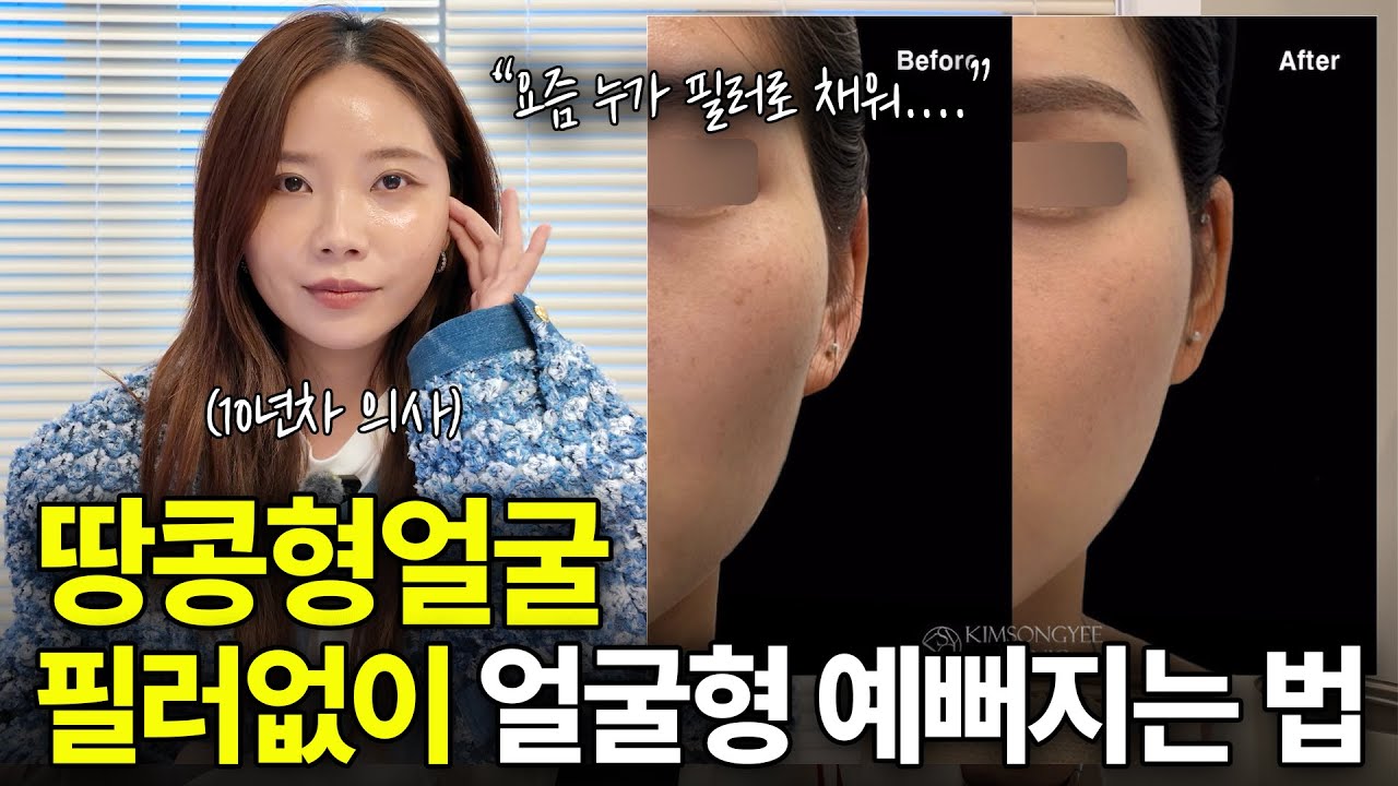 땅콩얼굴, 필러 맞지 마세요! 필러없이 얼굴형 예뻐지는 법 알려드립니다