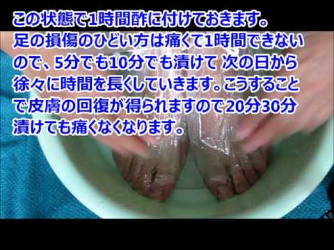 水虫完治法  How to cure Hong Kong foot 水虫完治法　除菌　白癬菌 JWHKGPS