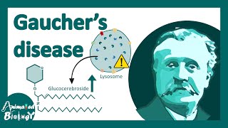 Gaucher's disease | classification, symptoms, pathology of Gaucher's disease.