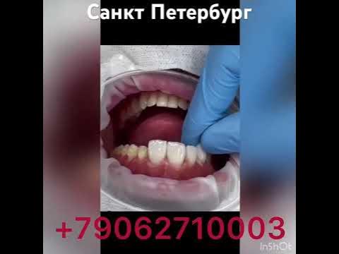Санкт Петербург -Стоматология-виниры - YouTube