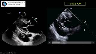 Transthoracic Echocardiography, Parasternal Views