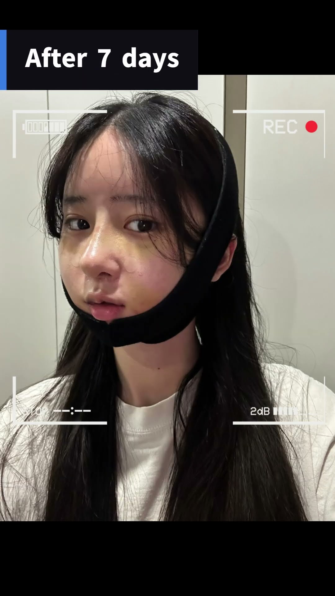 [Revision Rhinoplasty + Facial Contouring] Time for a change🔔