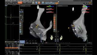 Non-fluoroscopic catheter positioning for SVT ablation