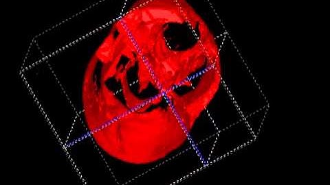 3D model of the adipose tissue from mid-thigh MRI