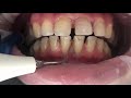 ASMR Dentist 🦷 Teeth Design and Teeth Cleaning l Dentist Cleans Your Teeth!!