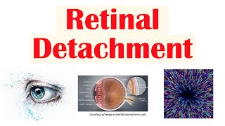 Retinal Detachment | Types, Risk Factors, Pathophysiology, Signs & Symptoms, Diagnosis, Treatment