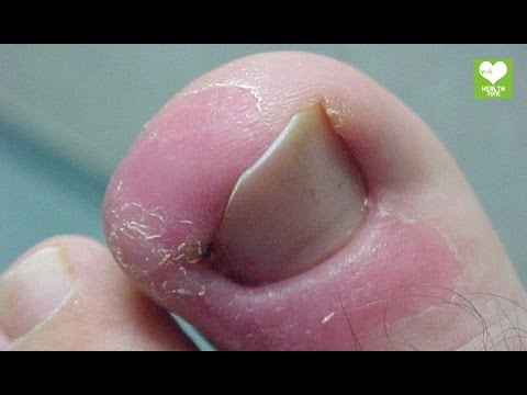 Home Remedies To Get Rid Of Ingrown Toenail | Health Tips - YouTube