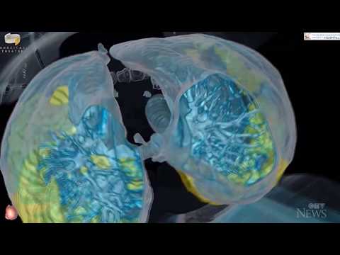 3D imaging shows how quickly COVID-19 can attack a healthy person's lungs