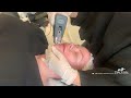 Quick clip of myself receiving the Moprheus8 treatment to tighten and rejuvenate skin!