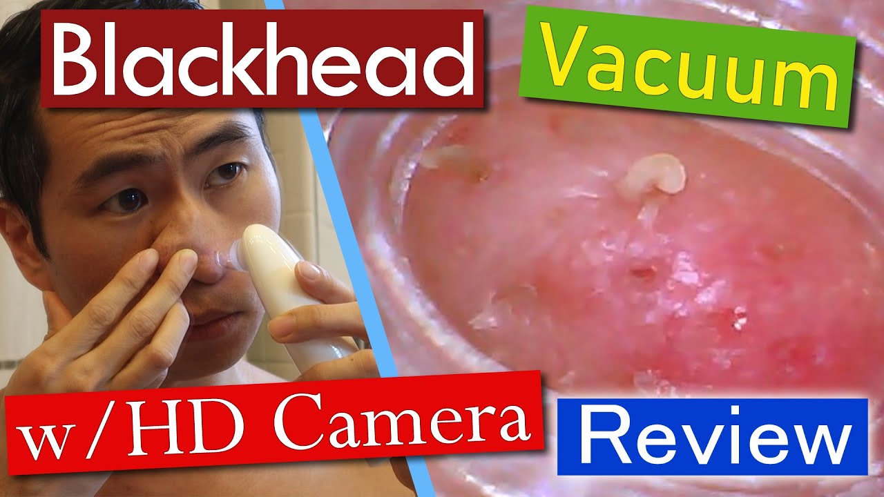 Visual Blackhead Removal Vacuum w/Builtin Camera Review YouTube