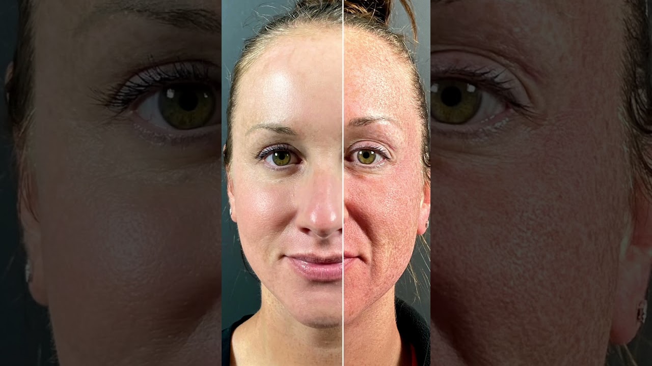 Moxi&trade; Laser Treatment Results!