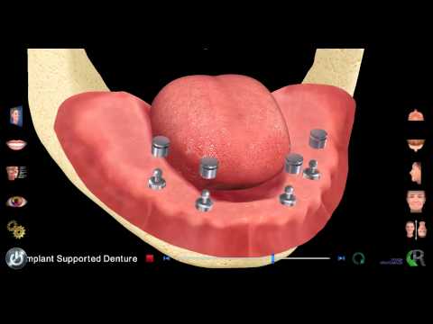 Periodontist in Ann Arbor, MI Shares Implant Retained Denture at Michigan Implants & Periodontics