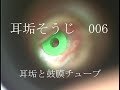 耳垢そうじ/鼓膜チューブと耳垢/006
