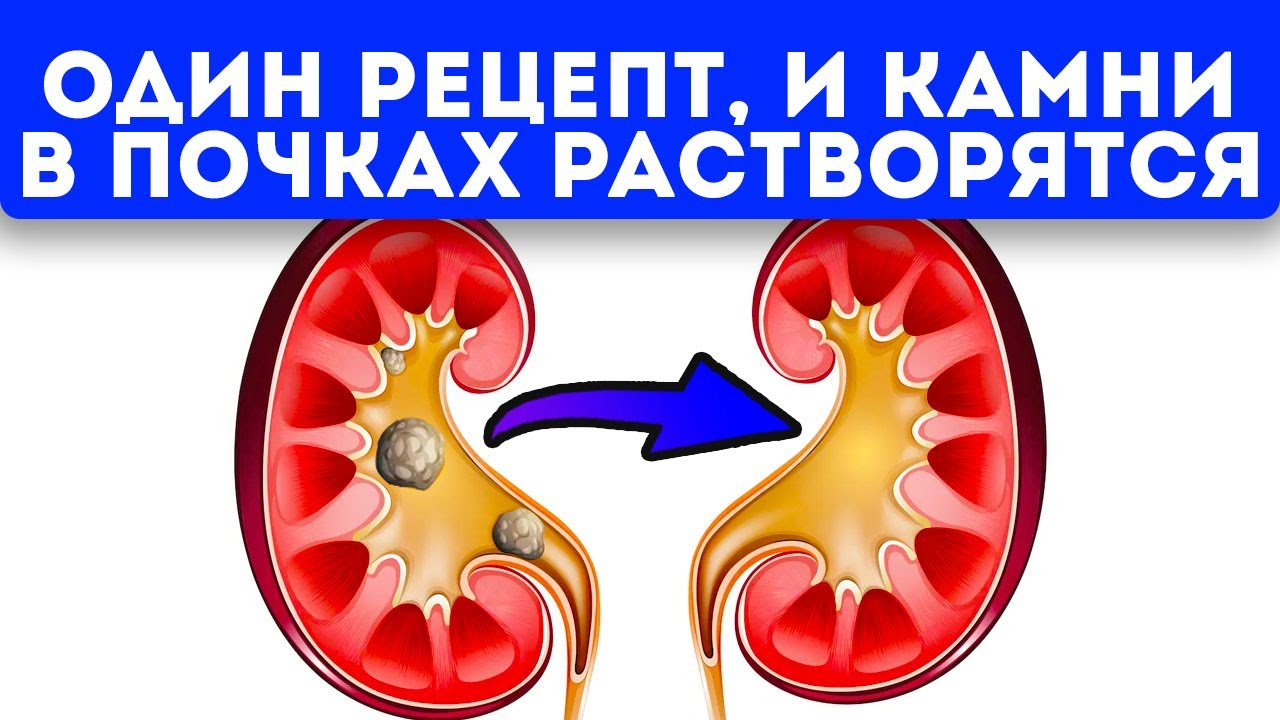 Вода от камней в почках. Препараты растворяющие почечные камни. Растворение почечных камней.