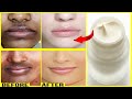 How To Remove Dark Black Patches And Hyperpigmentation Around Your Mouth Quickly