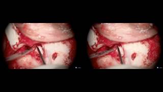 Radical mastoidectomy and facial nerve dissection (3d)