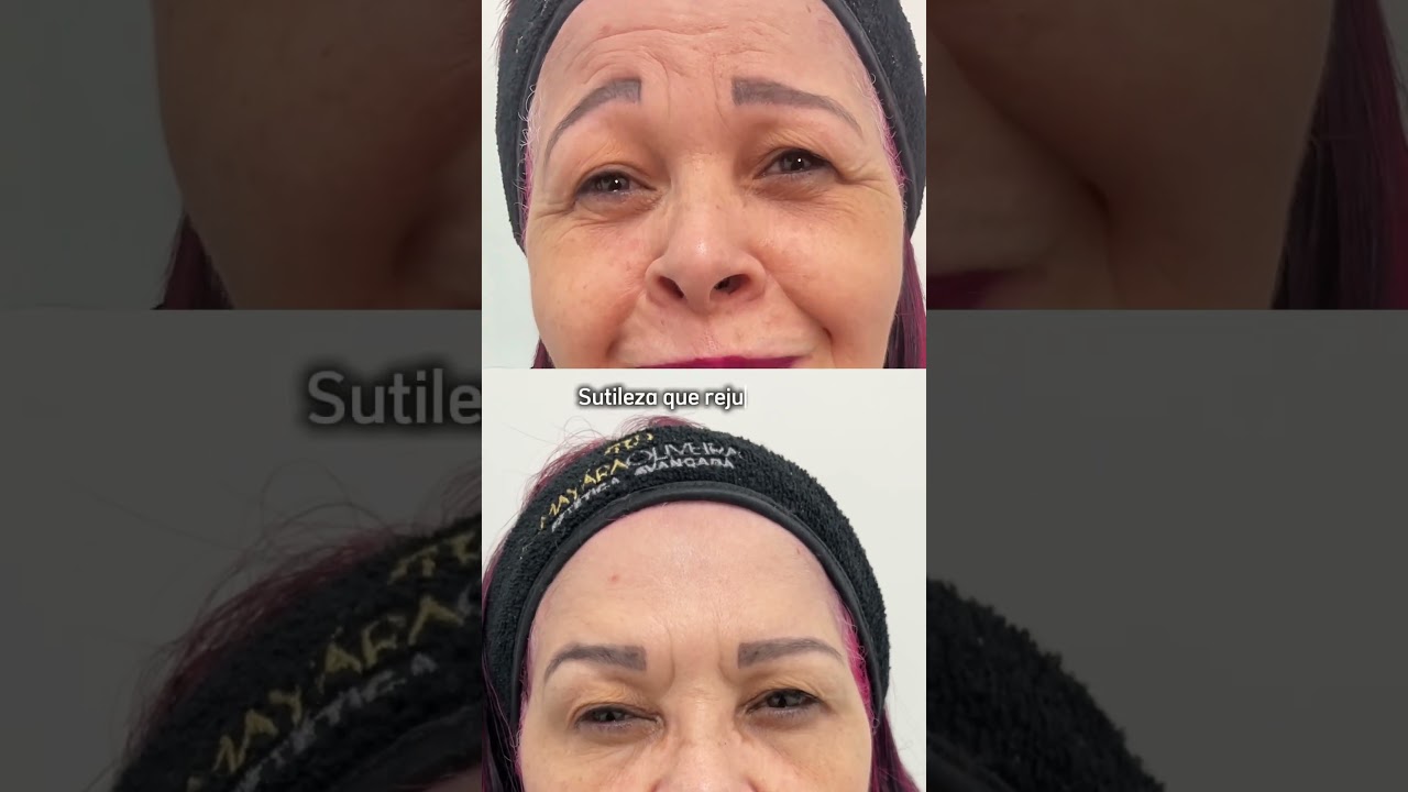 Suavizar as rugas é como renascer 