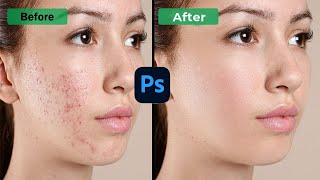 Advance High Level Skin Retouching In Photoshop / Remove Acne and Pimples