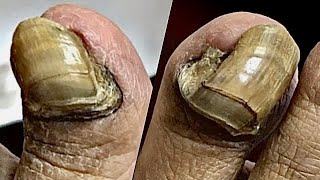 Extremely THICK and Sensitive NAIL CUTTING! **Patient Had To Be Numbed!!