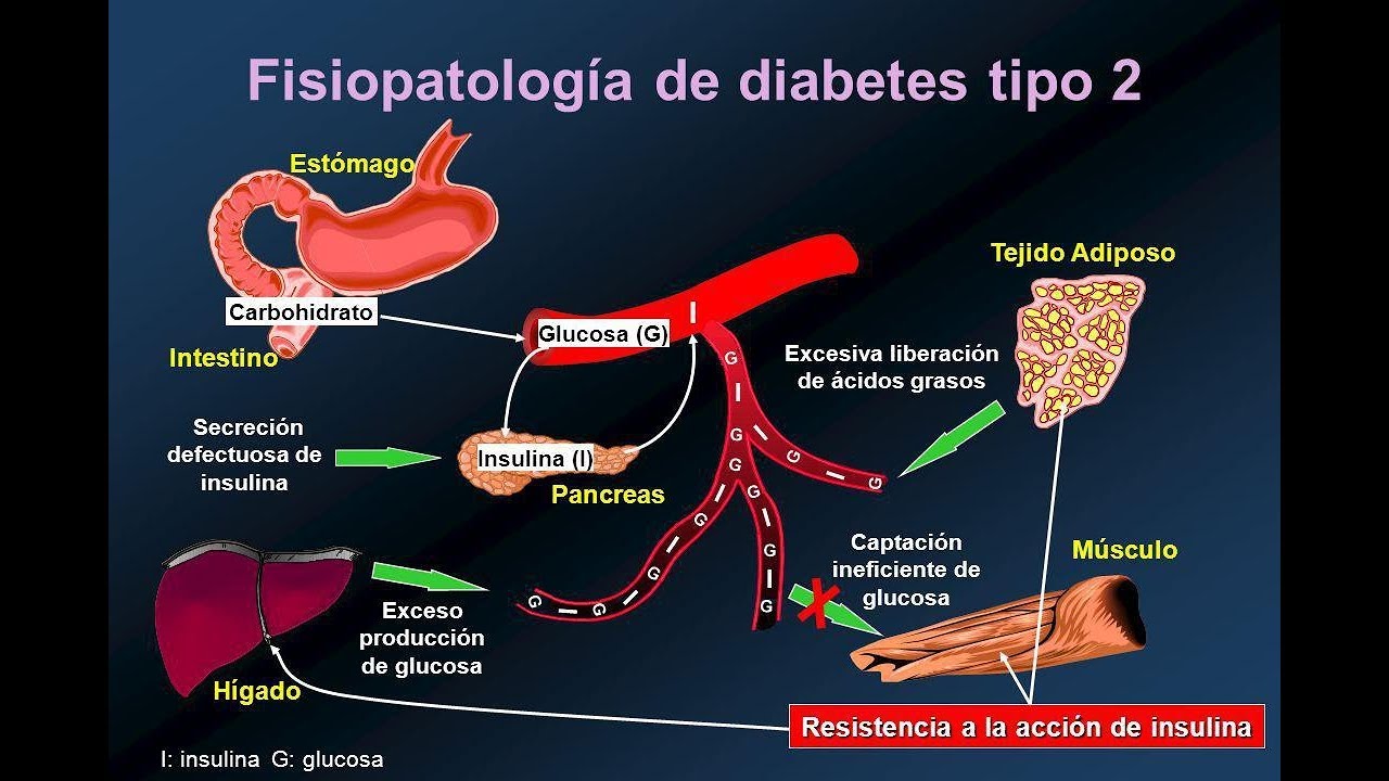 Cetosis diabetica sintomas