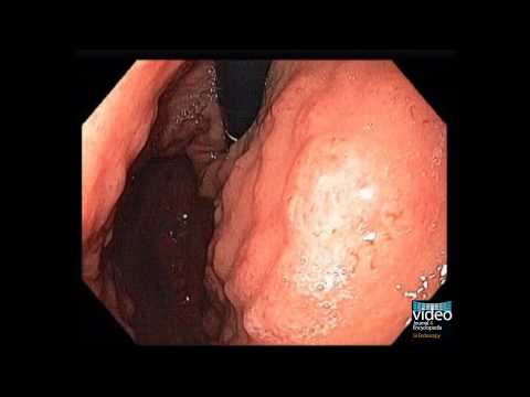 Intestinal Metaplasia of the Stomach