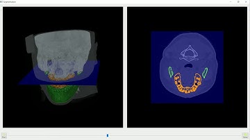 Fully-automated mandible & maxilla segmentation by deep learning developed by #ImagoWorks, Inc.