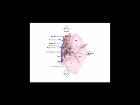 Video: Lobectomy: Määritelmä Ja Potilaan Koulutus