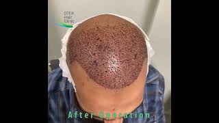 Otek Hair Clinic - Antalya Hair Transplant