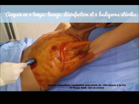 Vidéo: Efficacité Du Sirolimus Pour La Prévention Du Pneumothorax Récurrent Chez Les Patients Atteints De Lymphangioléiomyomatose: Une Série De Cas
