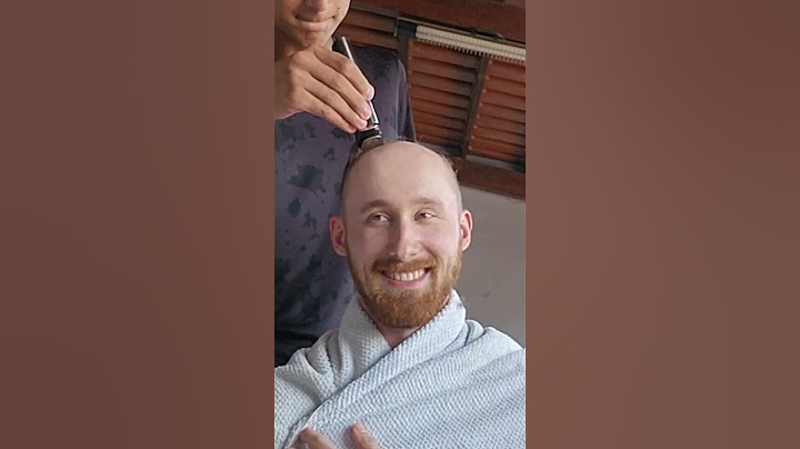 Overcoming My Balding Insecurity At 27