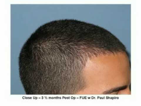 FUE hair transplant, hairline example by  Dr Paul Shapiro of Shapiro Medical Group