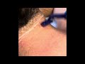Laser hair removal,  back of neck of a man