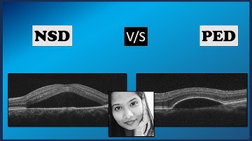 NSD v/s PED | Retina | OCT