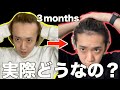 3ヶ月間AGAクリニックに通い続けた結果...めっちゃ生えた！【若ハゲ治療3ヶ月!!】【薄毛に悩んでいる人超必見動画!!】