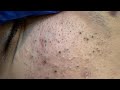 Soko Korean Skincare Routine (For Blackhead Removal &amp; Facial Rejuvenation)
