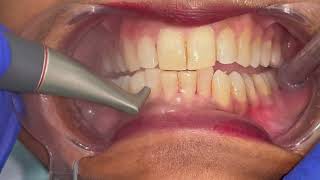 Teeth scaling and polishing by dentist