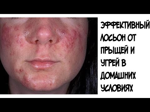 Лосьон для лица от прыщей и угревой сыпи в домашних условиях