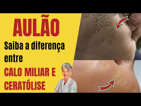 Vídeo: Diferença Entre Milho E Calo