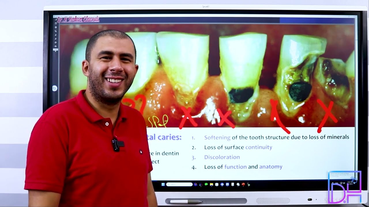 6- Classification of Dental Caries P1 ما هي أنواع التسوس المختلفة التى تصيب الأسنان الجزء الأول