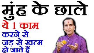 मुंह के छालों का सुपर रामबाण इलाज - How To Cure Mouth Ulcer by Sachin Goyal - Muh ke chhalo ka ilaj