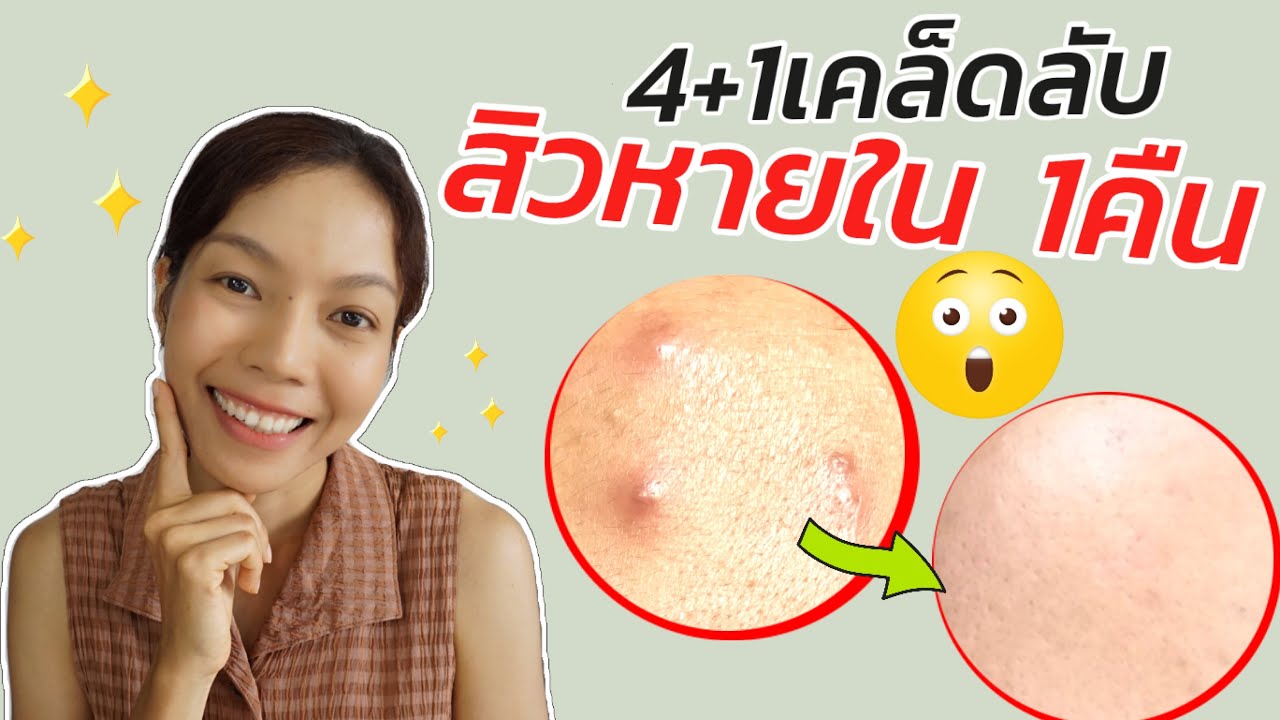 รักษาสิวเร่งด่วน สิวหาย1คืน สิวหายเร่งด่วน | รักษาสิว | เฮลตี้นี่ - Youtube