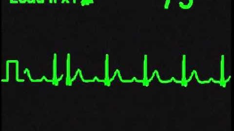 1st Degree AV Block - ECG Simulator - Arrhythmia Simulator