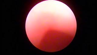 Rabdomiosarcoma Botrioides Vaginoscopia