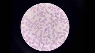 Malaria — Epidemiology, Treatment, and Prevention | NEJM